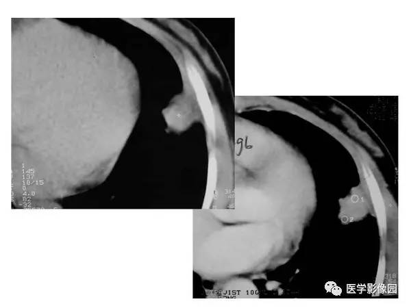 【PPT】肺球形结核的诊断——与周围型肺癌的鉴别