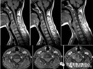 【病例】颈椎嗜酸性肉芽肿一例MR
