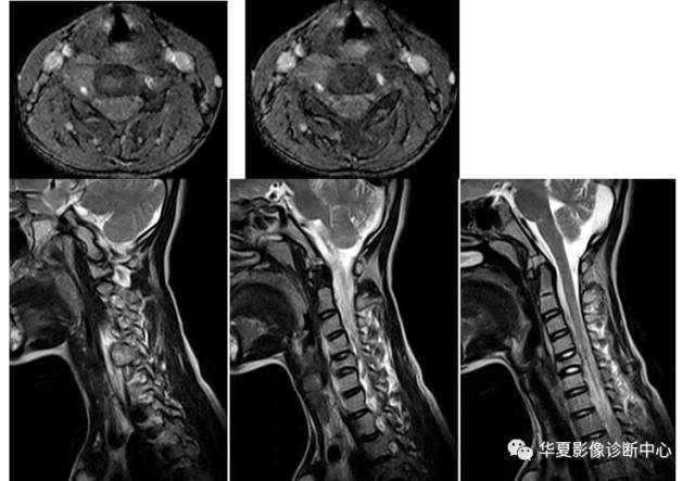 【病例】颈椎嗜酸性肉芽肿一例MR