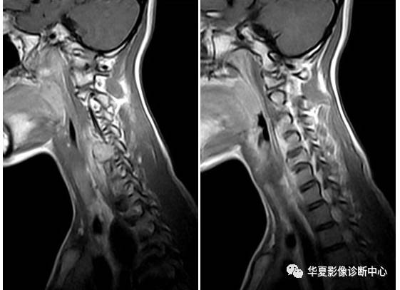【病例】颈椎嗜酸性肉芽肿一例MR