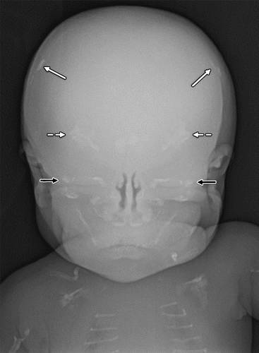 代谢性骨病的影像学表现:低磷酸酯酶症hypophosphatasia 代谢性骨病的影像学表现:低磷酸酯酶症hypophosphatasia