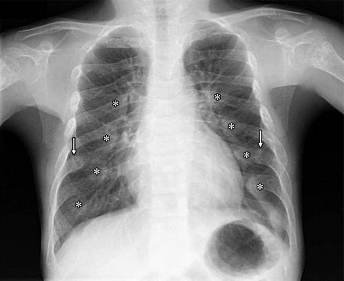 代谢性骨病的影像学表现:低磷酸酯酶症hypophosphatasia 代谢性骨病的影像学表现:低磷酸酯酶症hypophosphatasia