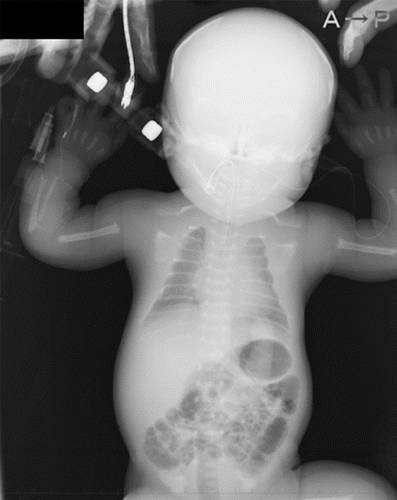 代谢性骨病的影像学表现:低磷酸酯酶症hypophosphatasia 代谢性骨病的影像学表现:低磷酸酯酶症hypophosphatasia
