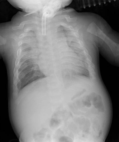 代谢性骨病的影像学表现:低磷酸酯酶症hypophosphatasia 代谢性骨病的影像学表现:低磷酸酯酶症hypophosphatasia