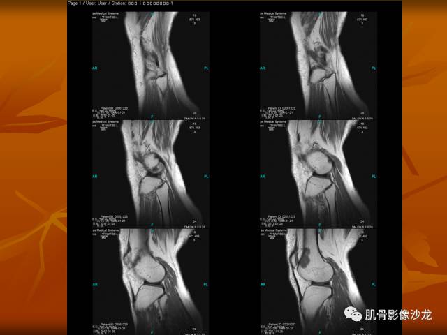 【病例】两例X线阴性的股骨干骺端占位性病变X线MR 【病例】两例X线阴性的股骨干骺端占位性病变X线MR