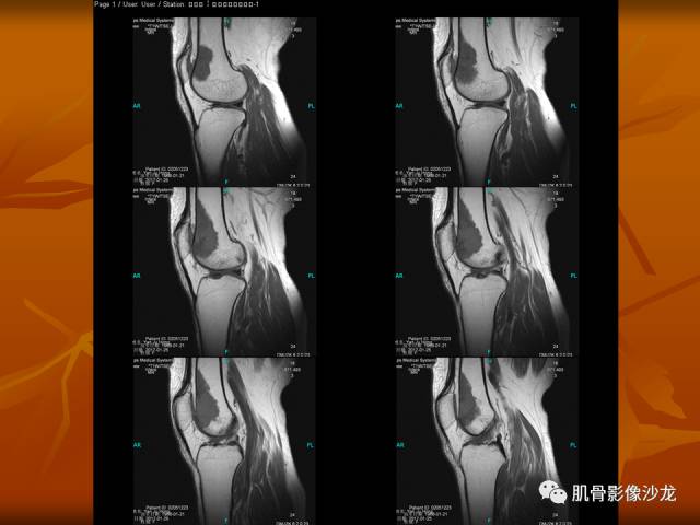 【病例】两例X线阴性的股骨干骺端占位性病变X线MR 【病例】两例X线阴性的股骨干骺端占位性病变X线MR