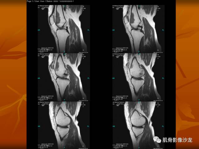 【病例】两例X线阴性的股骨干骺端占位性病变X线MR 【病例】两例X线阴性的股骨干骺端占位性病变X线MR