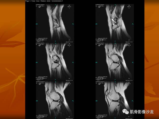 【病例】两例X线阴性的股骨干骺端占位性病变X线MR 【病例】两例X线阴性的股骨干骺端占位性病变X线MR