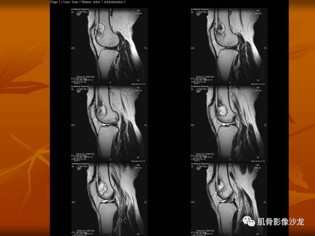 【病例】两例X线阴性的股骨干骺端占位性病变X线MR 【病例】两例X线阴性的股骨干骺端占位性病变X线MR