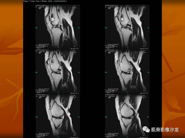 【病例】两例X线阴性的股骨干骺端占位性病变X线MR 【病例】两例X线阴性的股骨干骺端占位性病变X线MR