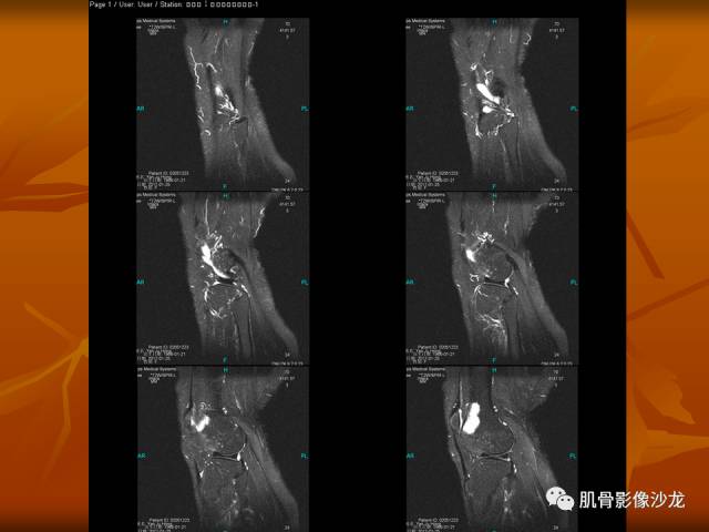 【病例】两例X线阴性的股骨干骺端占位性病变X线MR 【病例】两例X线阴性的股骨干骺端占位性病变X线MR