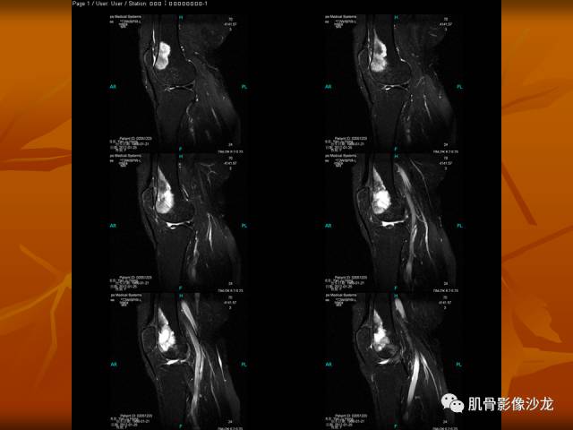 【病例】两例X线阴性的股骨干骺端占位性病变X线MR 【病例】两例X线阴性的股骨干骺端占位性病变X线MR