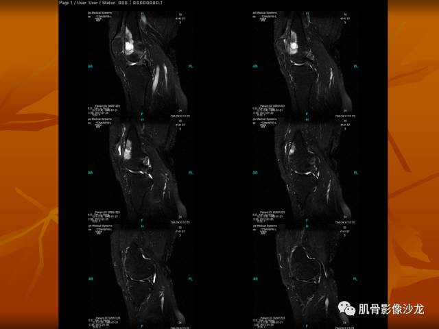 【病例】两例X线阴性的股骨干骺端占位性病变X线MR 【病例】两例X线阴性的股骨干骺端占位性病变X线MR