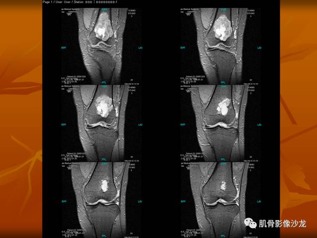 【病例】两例X线阴性的股骨干骺端占位性病变X线MR 【病例】两例X线阴性的股骨干骺端占位性病变X线MR