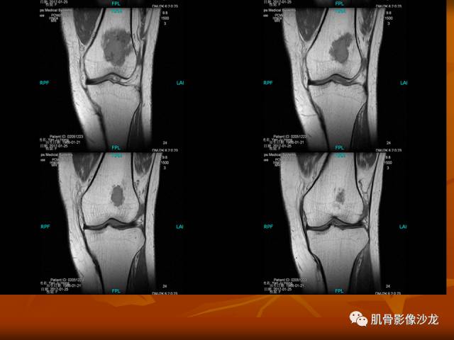 【病例】两例X线阴性的股骨干骺端占位性病变X线MR 【病例】两例X线阴性的股骨干骺端占位性病变X线MR