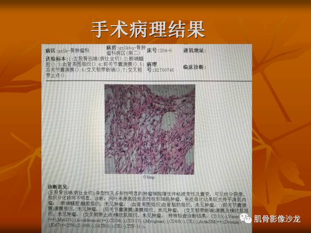 【病例】两例X线阴性的股骨干骺端占位性病变X线MR 【病例】两例X线阴性的股骨干骺端占位性病变X线MR