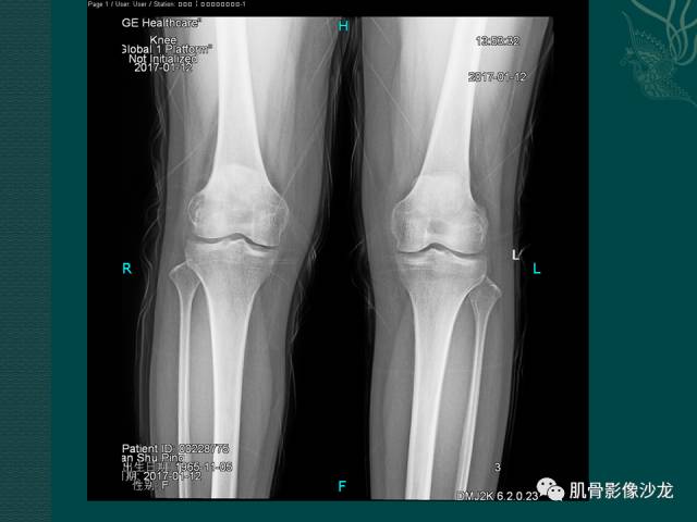 【病例】两例X线阴性的股骨干骺端占位性病变X线MR 【病例】两例X线阴性的股骨干骺端占位性病变X线MR