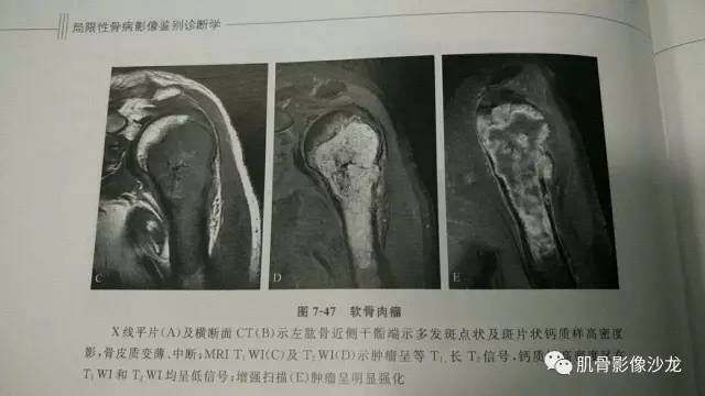 【病例】两例X线阴性的股骨干骺端占位性病变X线MR 【病例】两例X线阴性的股骨干骺端占位性病变X线MR
