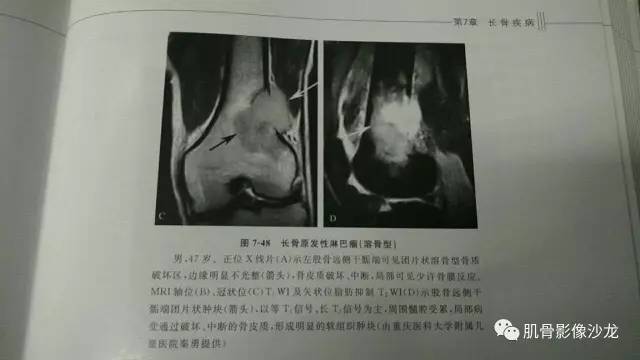 【病例】两例X线阴性的股骨干骺端占位性病变X线MR 【病例】两例X线阴性的股骨干骺端占位性病变X线MR