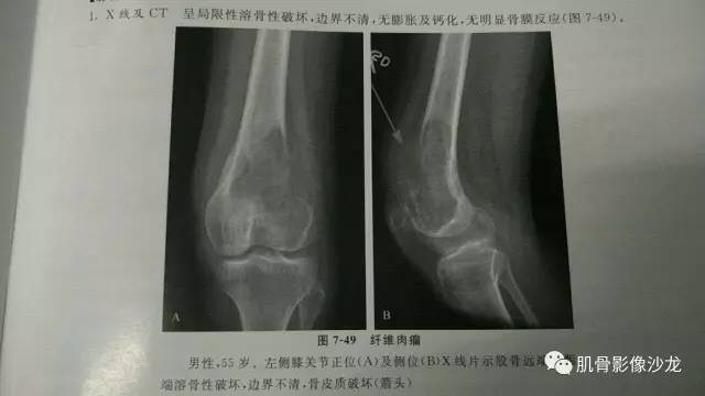 【病例】两例X线阴性的股骨干骺端占位性病变X线MR 【病例】两例X线阴性的股骨干骺端占位性病变X线MR