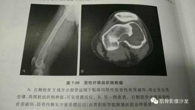 【病例】两例X线阴性的股骨干骺端占位性病变X线MR 【病例】两例X线阴性的股骨干骺端占位性病变X线MR