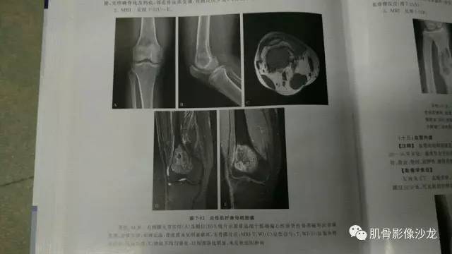 【病例】两例X线阴性的股骨干骺端占位性病变X线MR 【病例】两例X线阴性的股骨干骺端占位性病变X线MR
