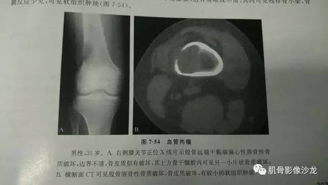 【病例】两例X线阴性的股骨干骺端占位性病变X线MR 【病例】两例X线阴性的股骨干骺端占位性病变X线MR
