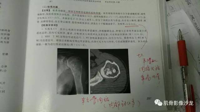 【病例】两例X线阴性的股骨干骺端占位性病变X线MR 【病例】两例X线阴性的股骨干骺端占位性病变X线MR