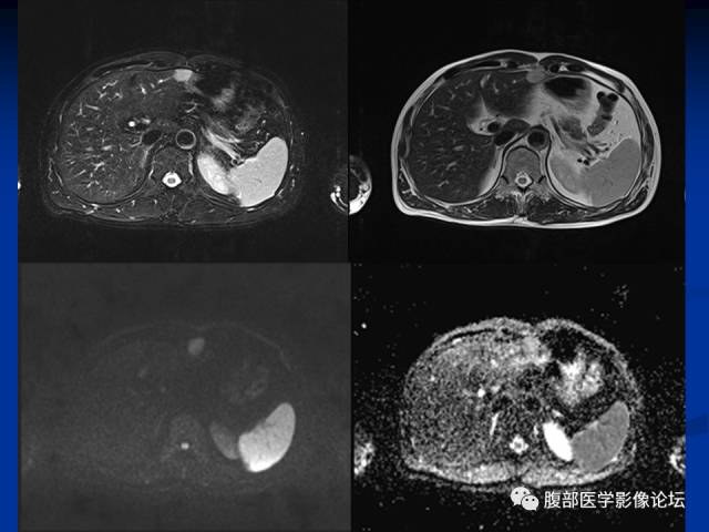 【病例】胃神经内分泌瘤伴肝转移1例MR 【病例】胃神经内分泌瘤伴肝转移1例MR