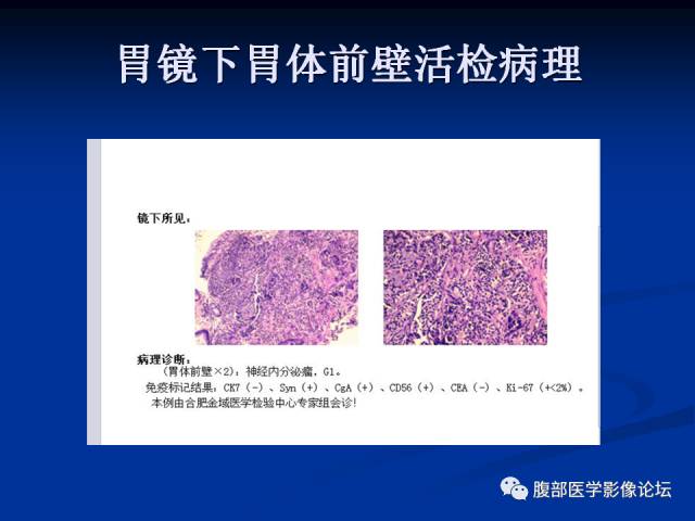 【病例】胃神经内分泌瘤伴肝转移1例MR 【病例】胃神经内分泌瘤伴肝转移1例MR