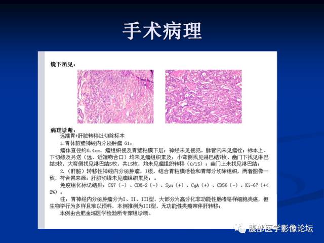 【病例】胃神经内分泌瘤伴肝转移1例MR 【病例】胃神经内分泌瘤伴肝转移1例MR
