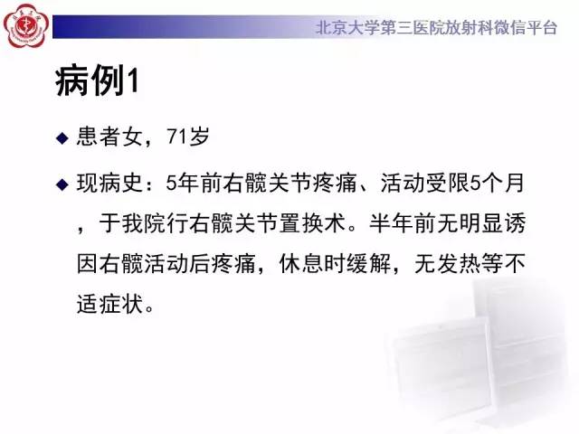 【病例】髋关节置换术后假体松动2例X线