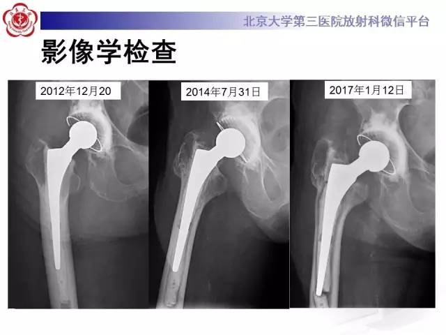 【病例】髋关节置换术后假体松动2例X线