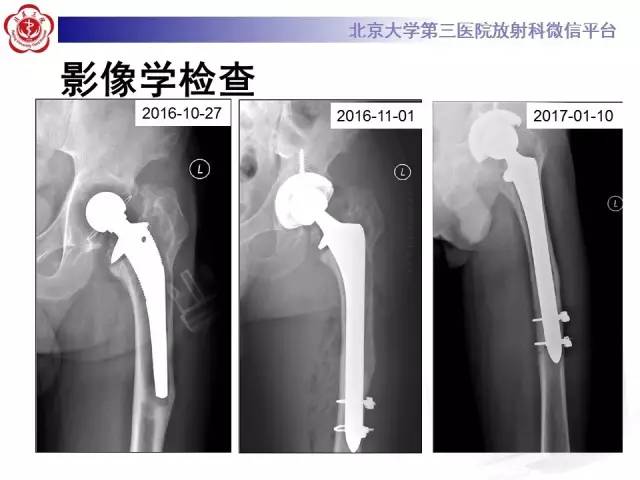 【病例】髋关节置换术后假体松动2例X线