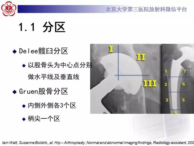 【病例】髋关节置换术后假体松动2例X线