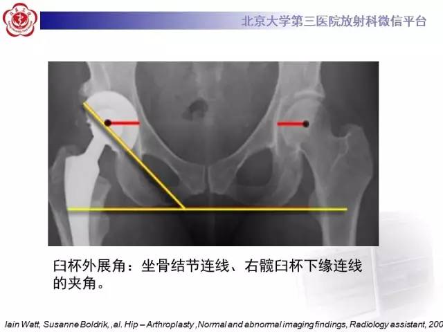 【病例】髋关节置换术后假体松动2例X线