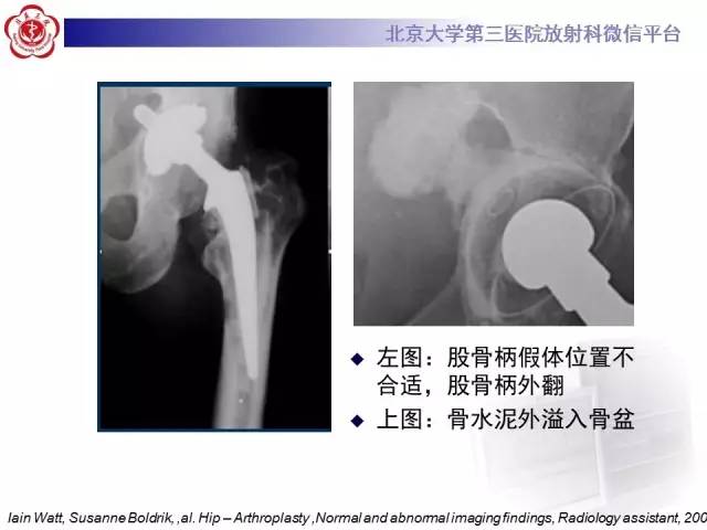 【病例】髋关节置换术后假体松动2例X线