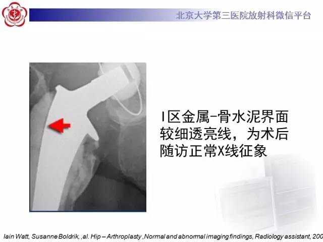 【病例】髋关节置换术后假体松动2例X线