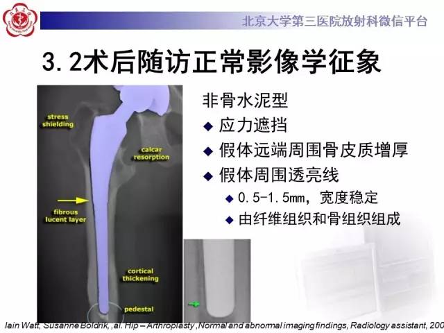 【病例】髋关节置换术后假体松动2例X线