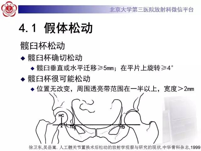 【病例】髋关节置换术后假体松动2例X线