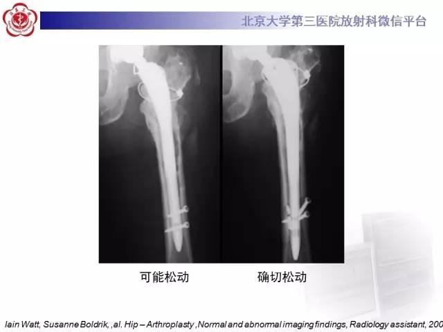 【病例】髋关节置换术后假体松动2例X线