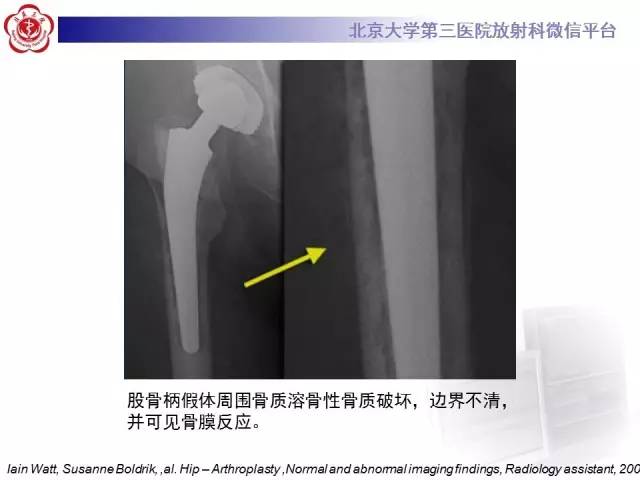 【病例】髋关节置换术后假体松动2例X线