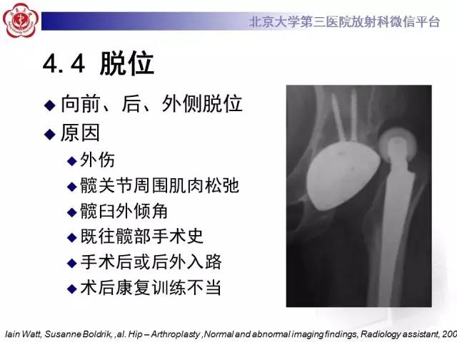 【病例】髋关节置换术后假体松动2例X线