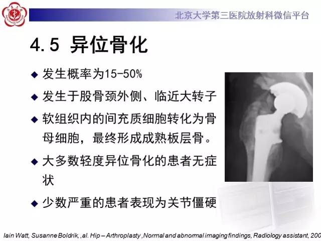 【病例】髋关节置换术后假体松动2例X线
