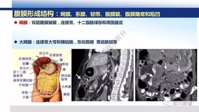 【PPT】腹膜解剖及炎性病变影像诊断