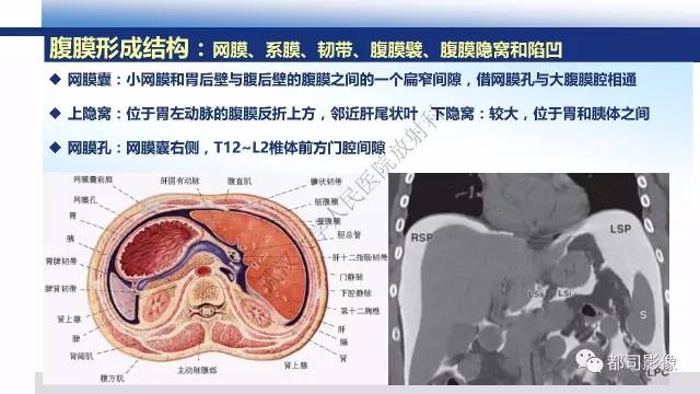【PPT】腹膜解剖及炎性病变影像诊断