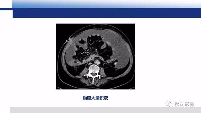 【PPT】腹膜解剖及炎性病变影像诊断