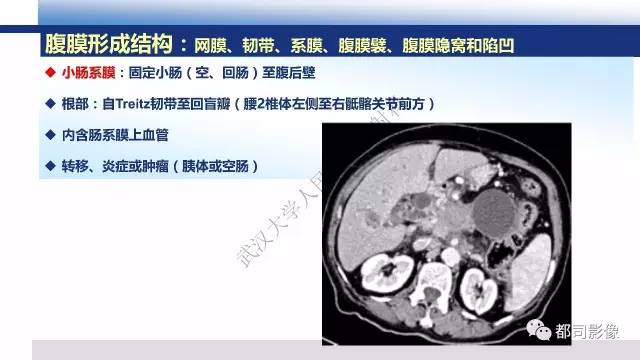 【PPT】腹膜解剖及炎性病变影像诊断