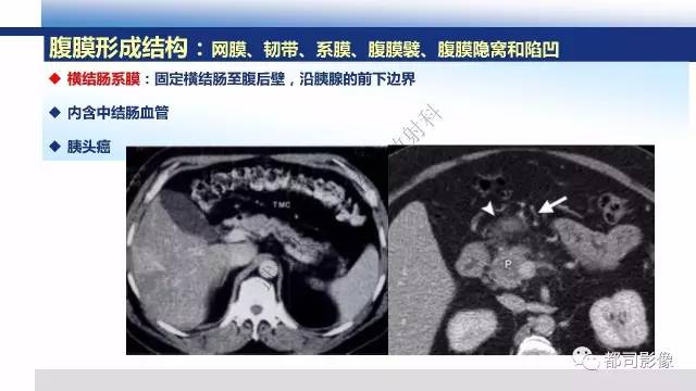 【PPT】腹膜解剖及炎性病变影像诊断