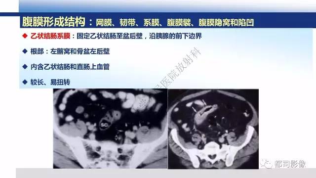 【PPT】腹膜解剖及炎性病变影像诊断